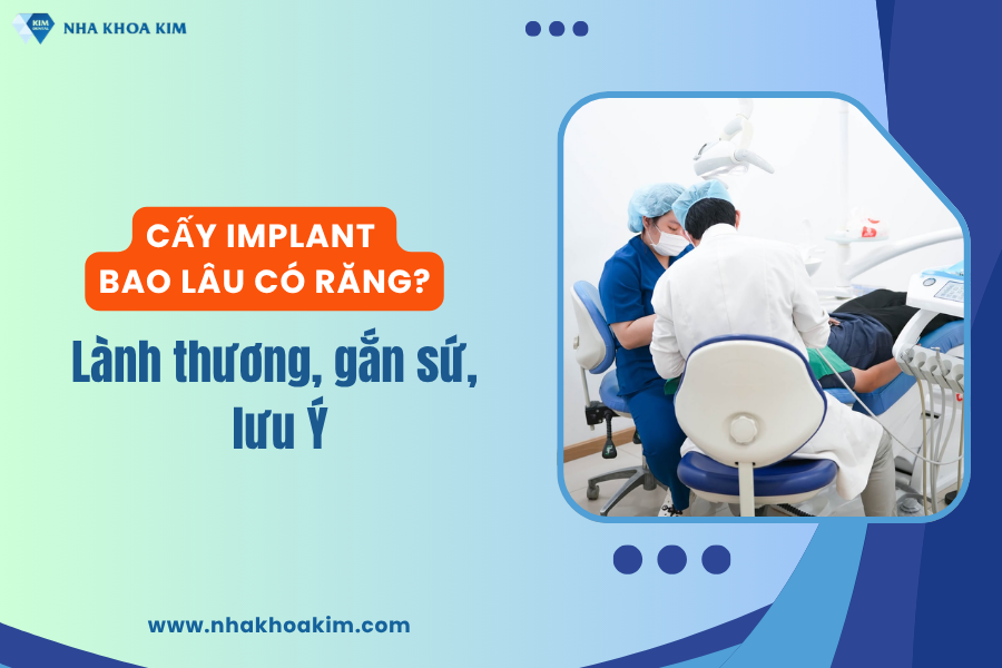 Cấy Implant Bao Lâu Có Răng? Lành Thương, Gắn Sứ, Lưu Ý